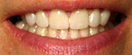 Patient 2 After top front row of teeth restored