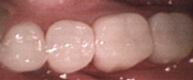 Patient 5 Teeth with tooth colored restoration