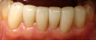 Patient 6 Fully restored bottom row of teeth