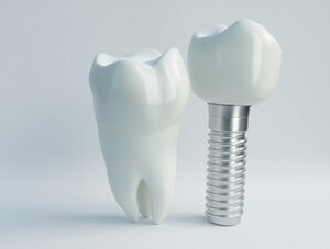 model of dental implants in Friendswood compared to natural tooth