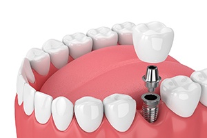 diagram of dental implants in Friendswood being placed