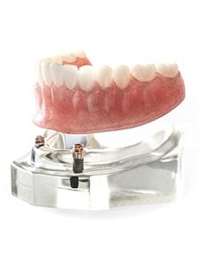 Dental implant supported dentures model on stand