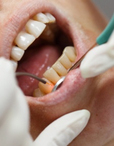 Closeup of patient during LightWalker laser dentistry treatment