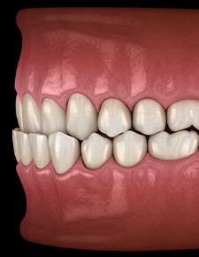 Illustration of an underbite