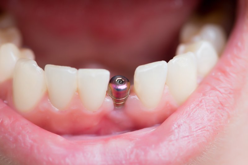 Single dental implant